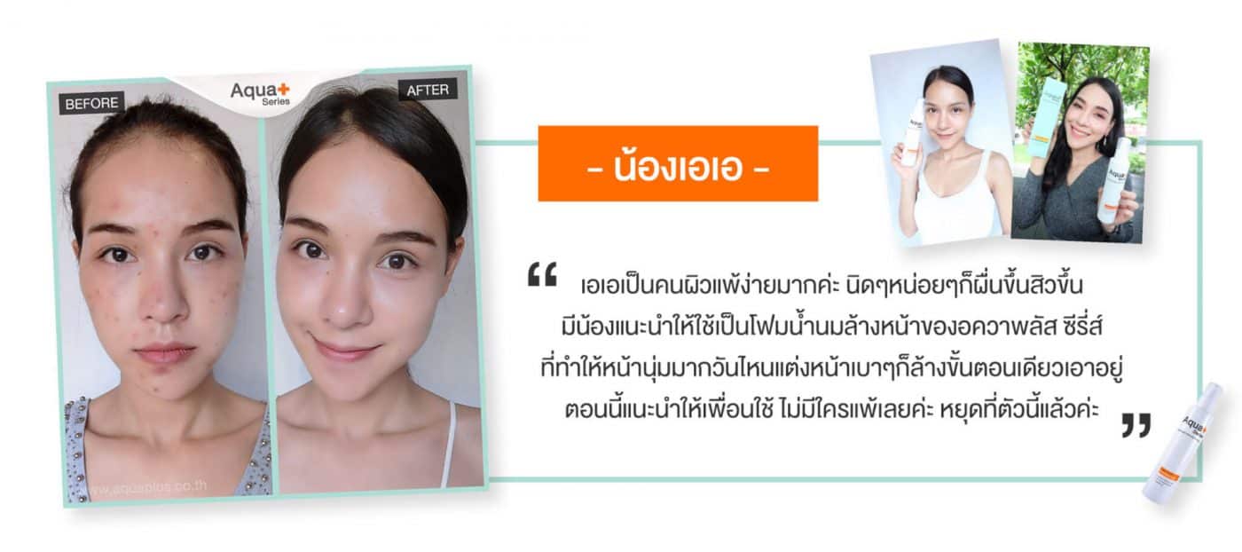 แนะนำโฟมล้างหน้าสำหรับรักษาสิวโดยเฉพาะ